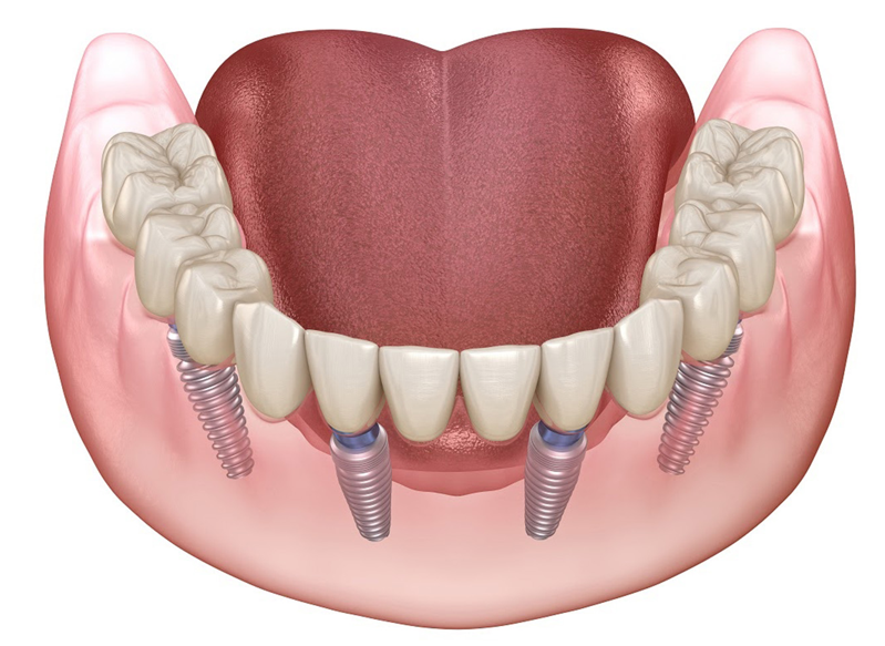 Full Mouth Rehabilitation