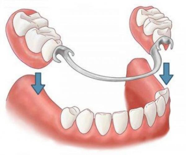 Removable Dentures: Functional and Comfortable Dental Treatment